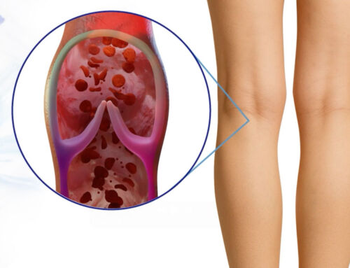 Video para producto farmacéutico para tratar várices